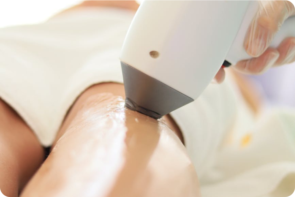 Fájdalommentes diódalézeres kezelés